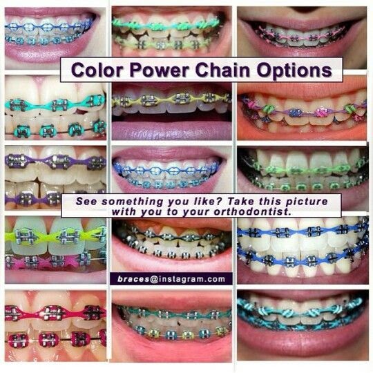 Navy Blue Braces Color Braces