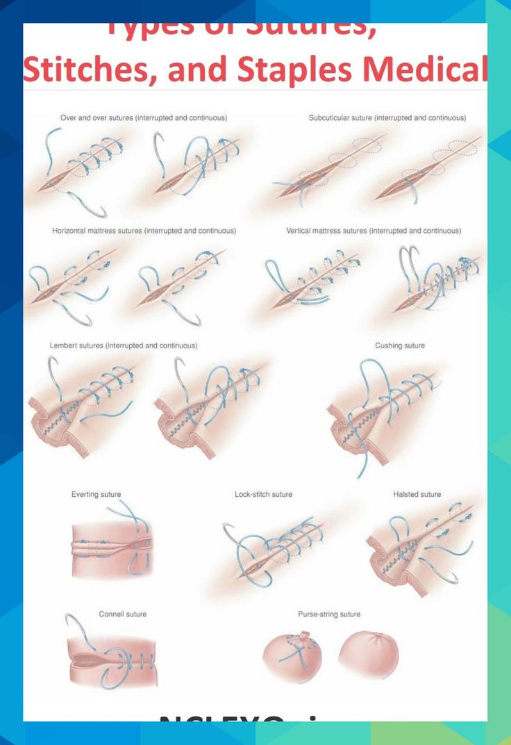 Types Of Sutures Stitches And Staples Medical Wound Care Suturing